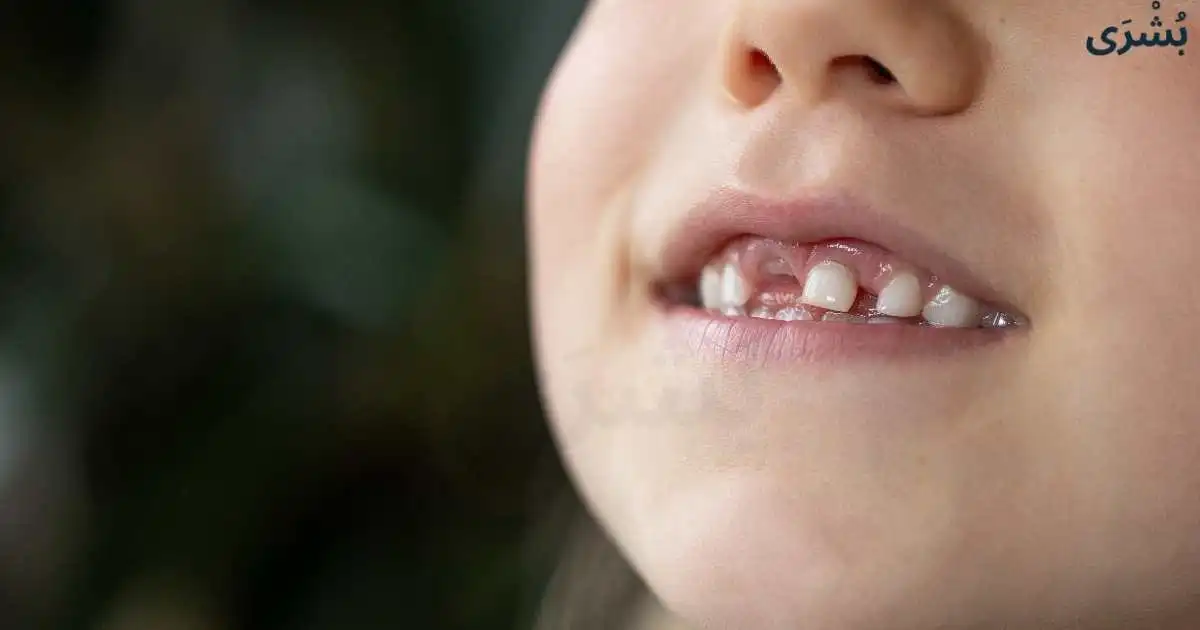 تفسير حلم سقوط الاسنان